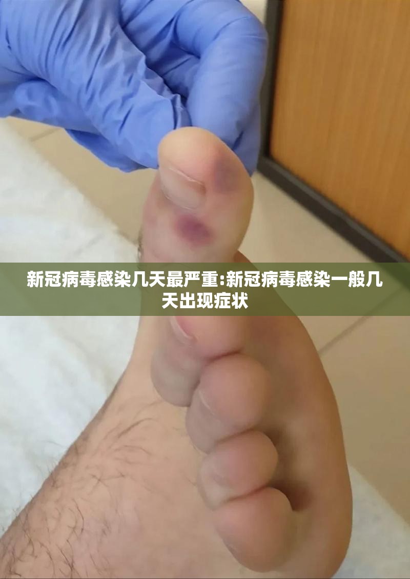 新冠病毒感染几天最严重:新冠病毒感染一般几天出现症状
