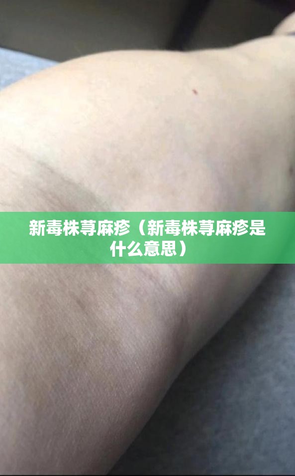 新毒株荨麻疹（新毒株荨麻疹是什么意思）